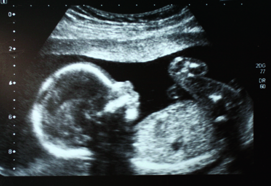 Scan of a baby